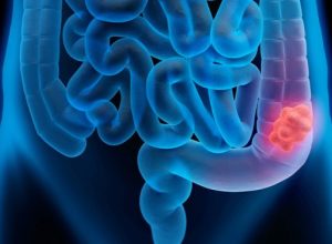 11-colorretal-intestino-reto-1-608x368-1